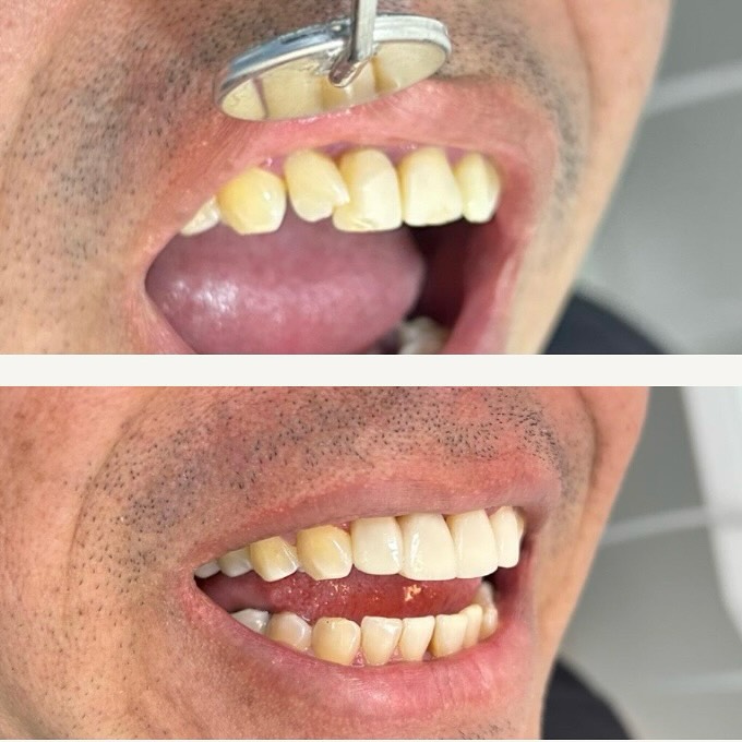 Montagem original de antes e depois de facetas, publicada no perfil da Clínica Soraya Queiroz